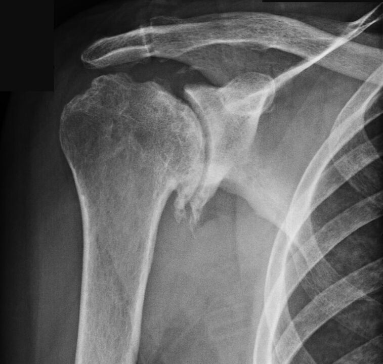 X-ray showed osteoarthritis of the shoulder