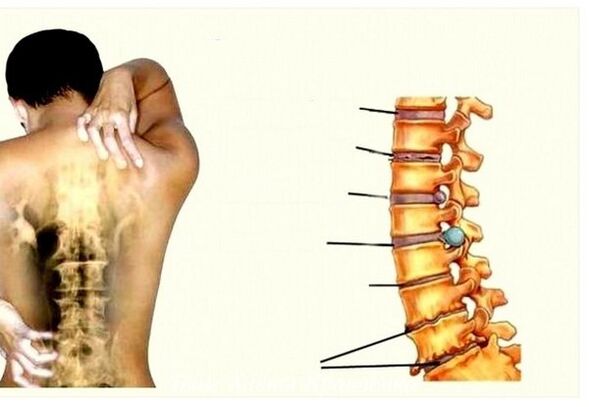 Cervical osteochondosis stages