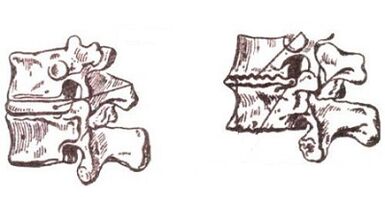 Stages of development of cervical osteochondosis