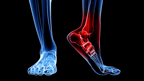 Arthritis of the ankle joint