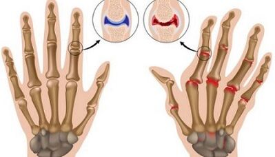 The main differences in arthritis and osteoarthritis