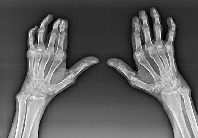 Diagnostics of finger joints