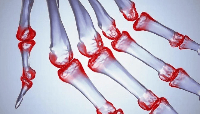 Pain in finger joints