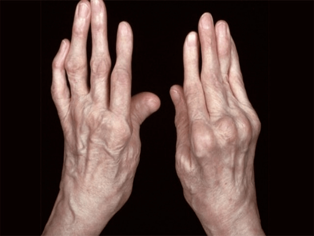 arthritis as a cause of pain in finger joints