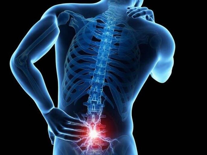 In radiculitis, pinched nerve roots cause sharp pain in the lower back