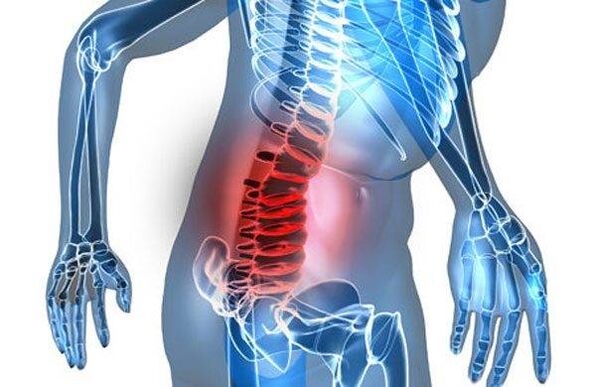Spinal deformity in the fourth stage of lumbar osteochondrosis