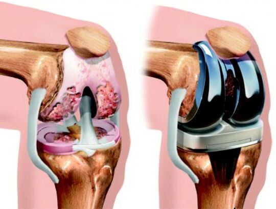 Stent replacement is a surgical treatment method in which the affected joint is replaced with a prosthesis.