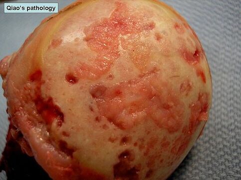 Cartilaginous surface affected by osteoarthritis