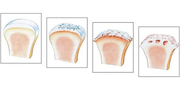 Healthy joint and 3 degrees of osteoarthritis development