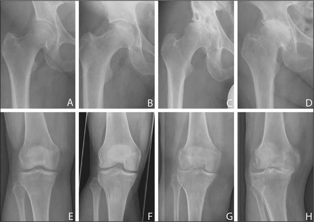 Stages of development of joint osteoarthritis on an x-ray