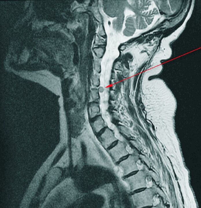 Intervertebral herniation of the cervical spine on MRI